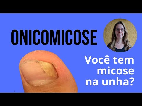 Tudo Sobre Onicomicose Micose De Unha Unheira Dra Renata Beranger